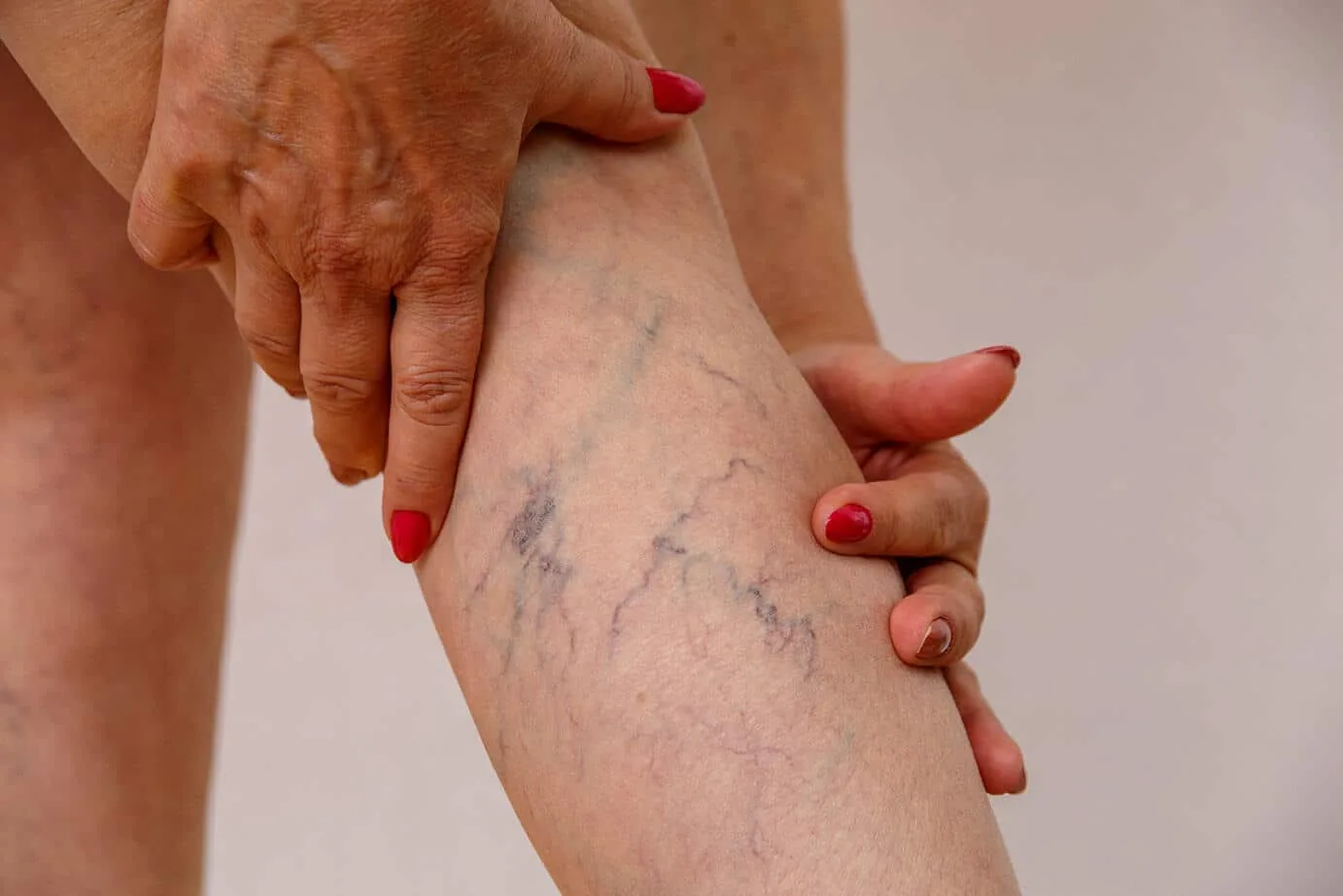 Woman pressing both hands around her calf, which shows visible spider veins