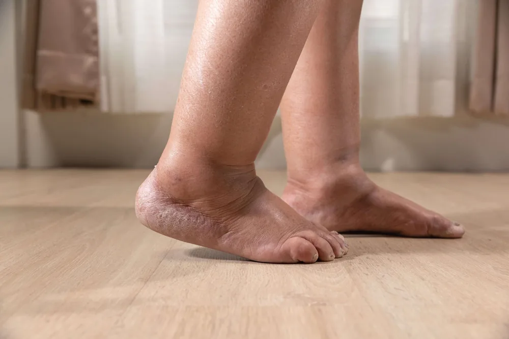 Bare feet on a wooden floor with swollen ankles and dry, discoloured skin