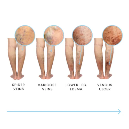 Vein disease progression: spider veins, varicose veins, lower leg edema, venous ulcer